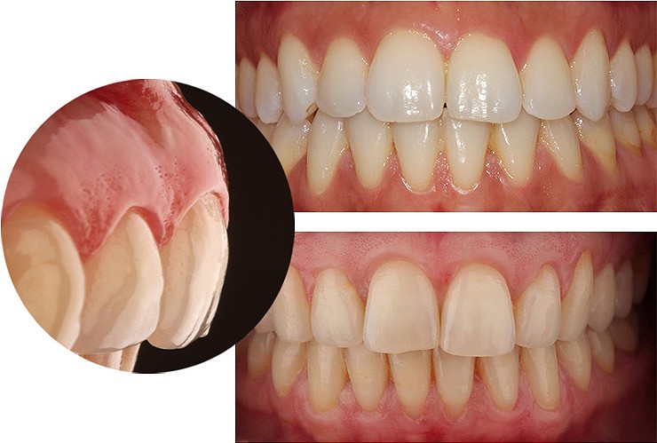La enfermedad periodontal