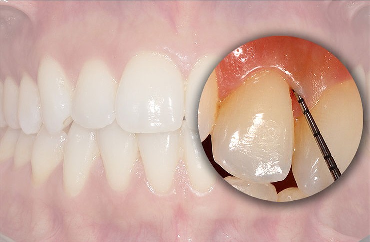 La enfermedad periodontal